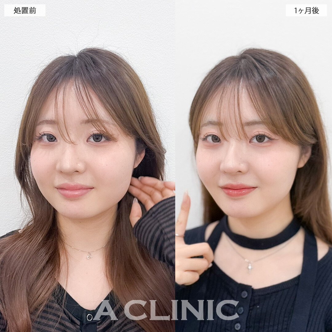 1day小顔脂肪吸引とバッカルファット除去術で不要な脂肪をなくしてナチュラルな小顔に！こちら処置前と1ヶ月後の症例です(20代女性)