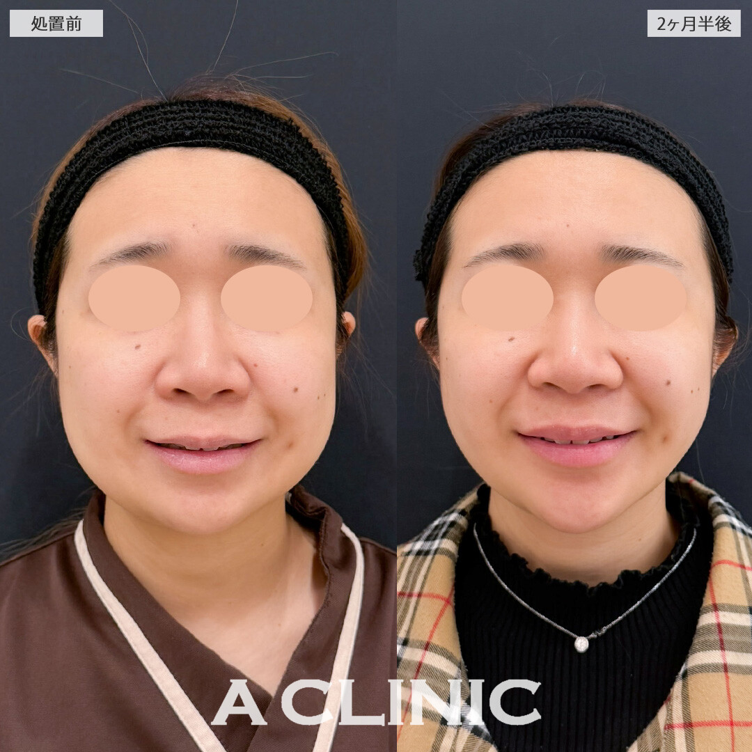 1day小顔脂肪吸引とバッカルファット除去術で全体的なお顔のボリューム感が落とせました！こちら処置前と2か月半後の症例です(20代女性)