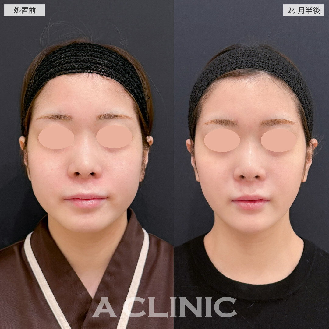 1day小顔脂肪吸引でいらない脂肪を一気に減らして自然と小顔に！こちら処置前と2か月半後の症例です(20代女性)