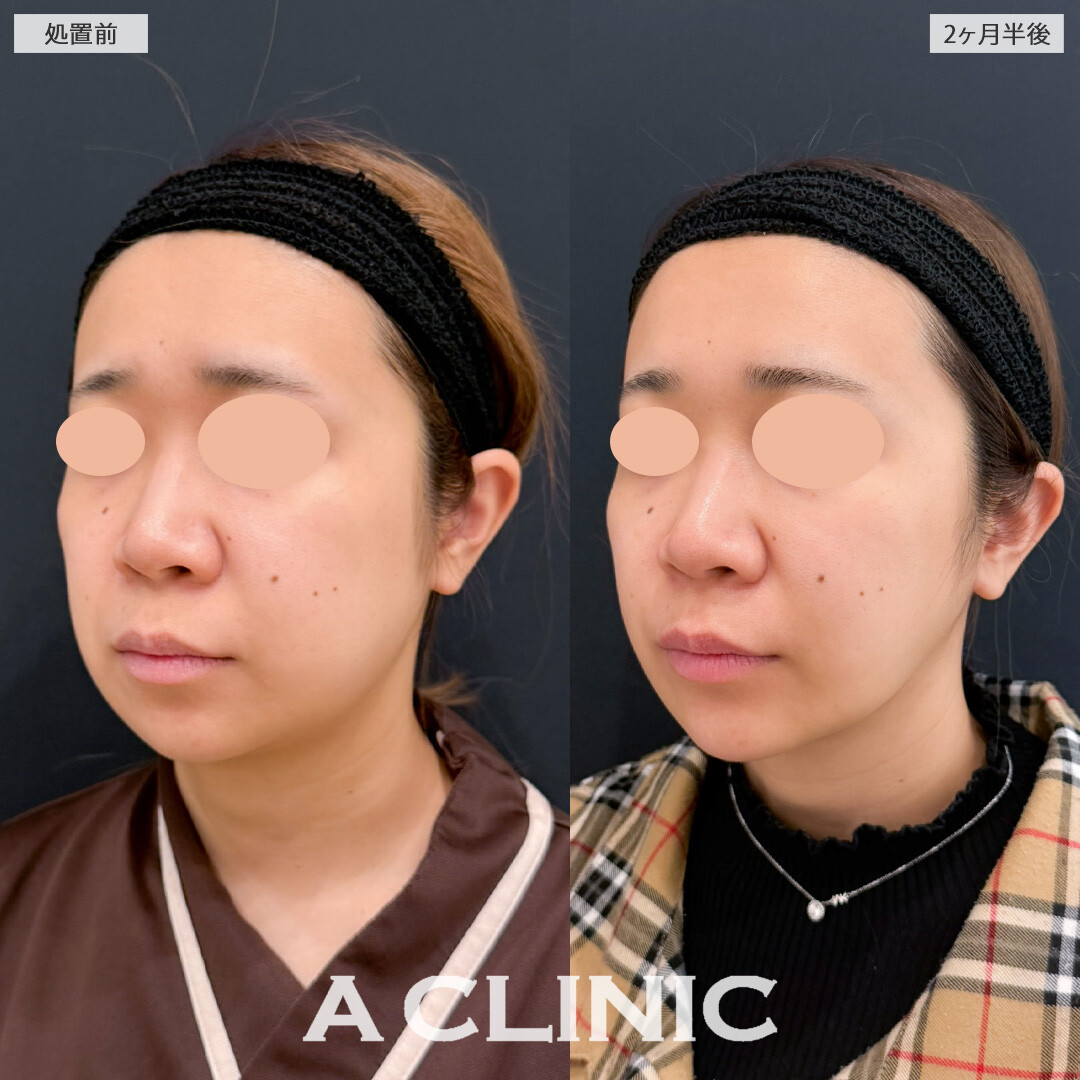 1day小顔脂肪吸引とバッカルファット除去術で全体的なお顔のボリューム感が落とせました！こちら処置前と2か月半後の症例です(20代女性)
