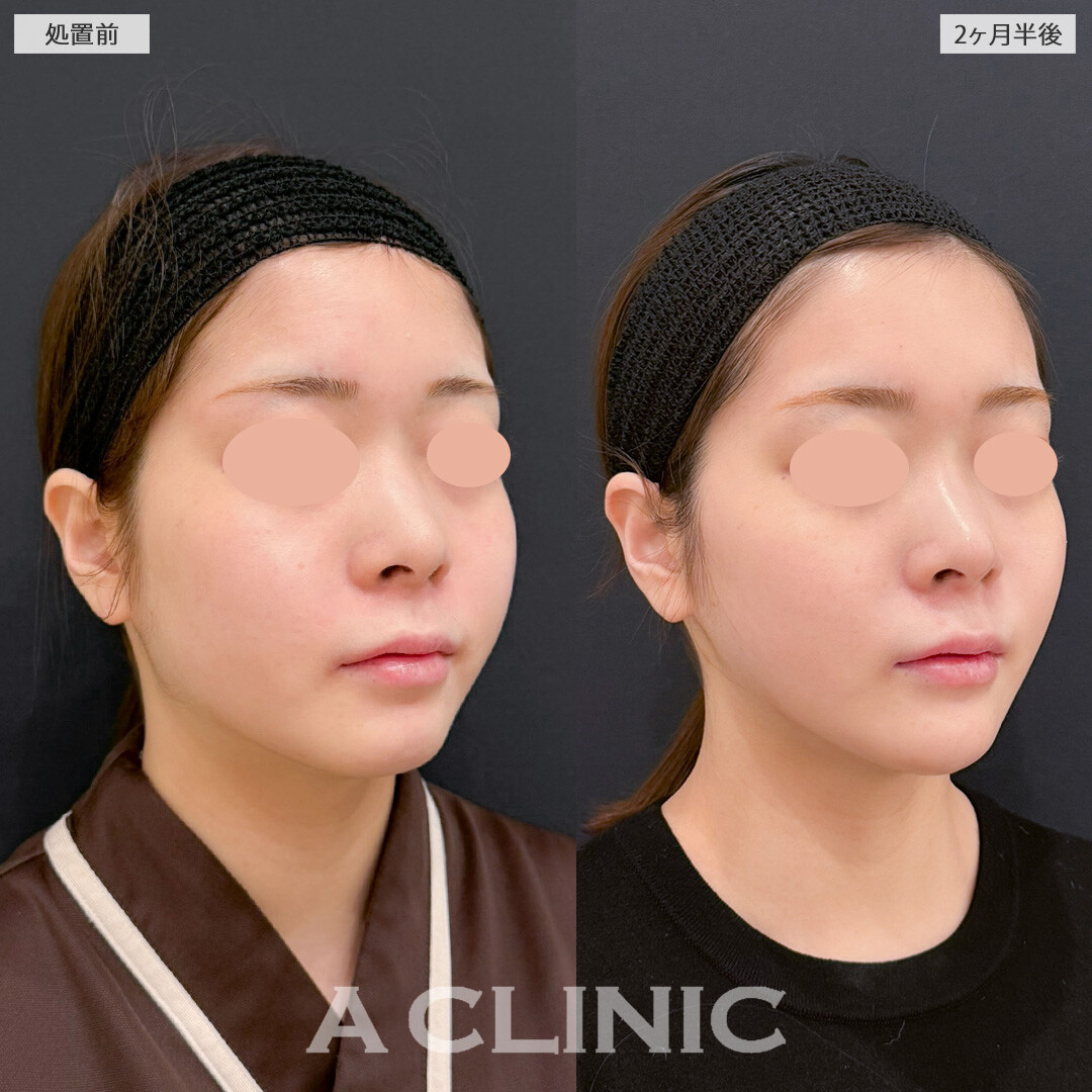 1day小顔脂肪吸引でいらない脂肪を一気に減らして自然と小顔に！こちら処置前と2か月半後の症例です(20代女性)