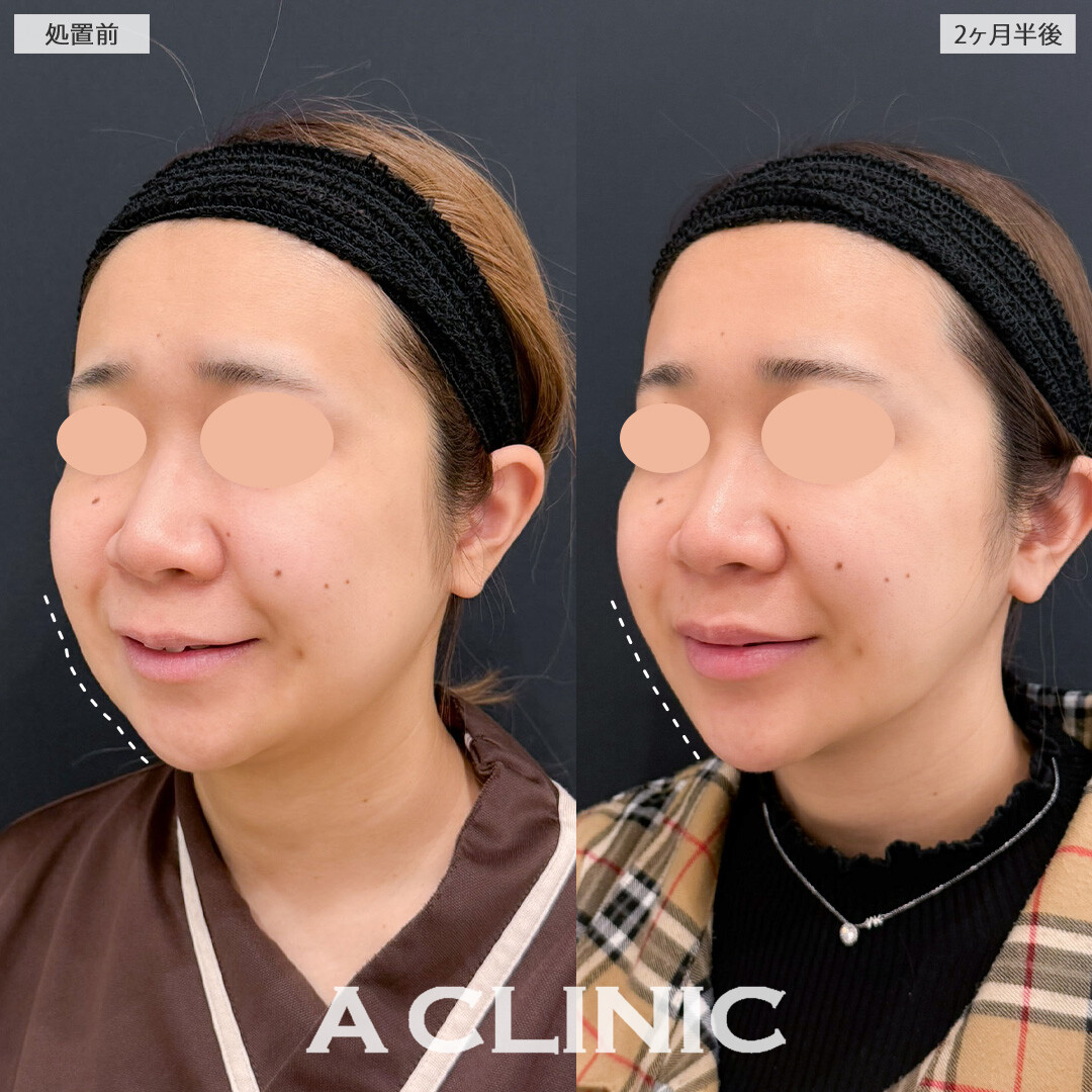1day小顔脂肪吸引とバッカルファット除去術で全体的なお顔のボリューム感が落とせました！こちら処置前と2か月半後の症例です(20代女性)