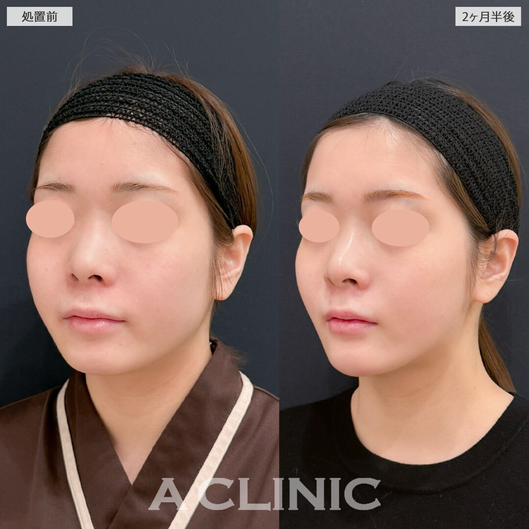 1day小顔脂肪吸引でいらない脂肪を一気に減らして自然と小顔に！こちら処置前と2か月半後の症例です(20代女性)