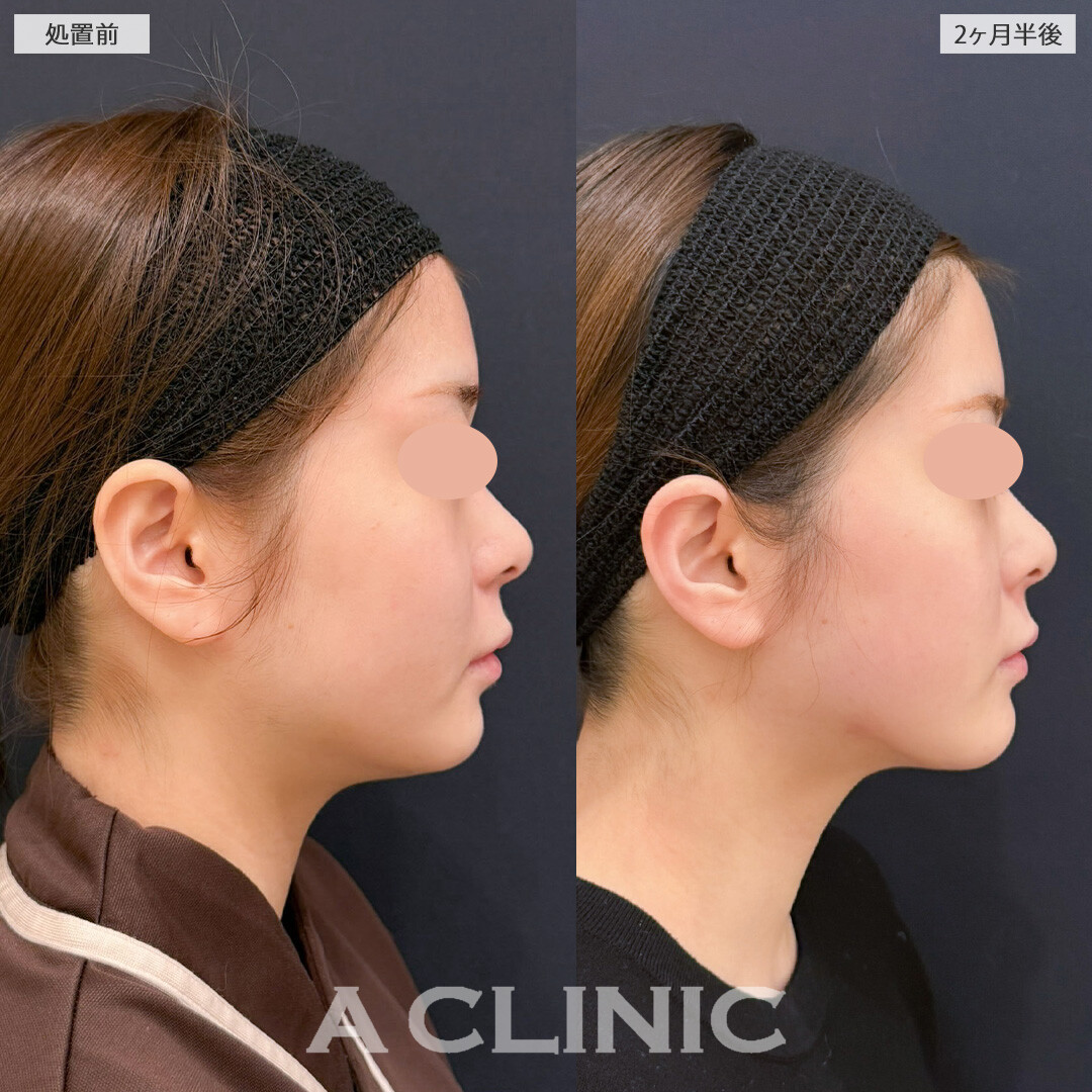 1day小顔脂肪吸引でいらない脂肪を一気に減らして自然と小顔に！こちら処置前と2か月半後の症例です(20代女性)