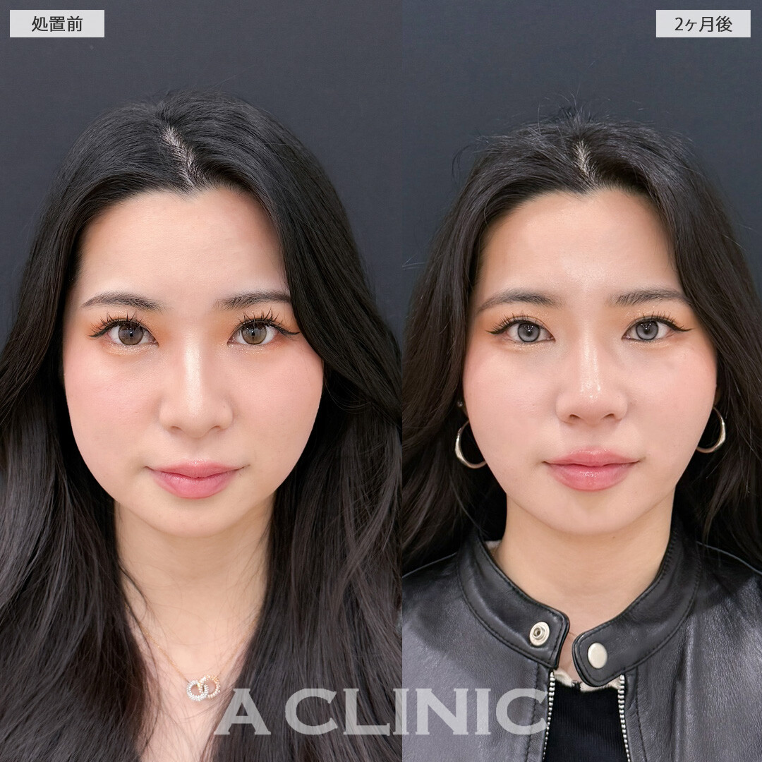 1day小顔脂肪吸引とバッカルファット除去術で丸顔感をなくして余白のないVフェイスに！こちら処置前と2ヶ月後の症例です(20代女性)