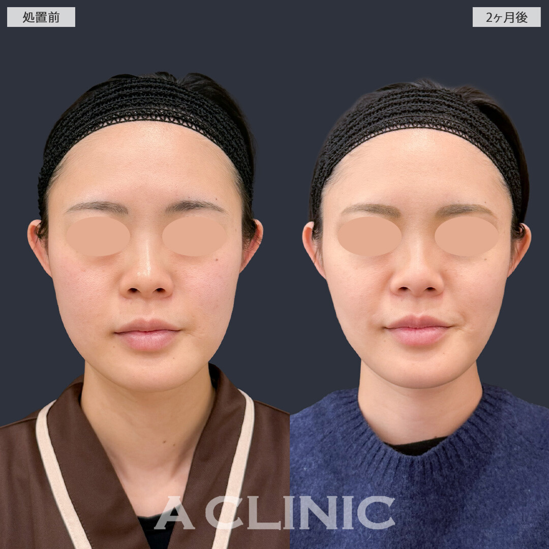 1day小顔脂肪吸引とバッカルファット除去術でお顔の余白を減らしてナチュラルな小顔に！こちら処置前と2ヶ月後の症例です(30代女性)