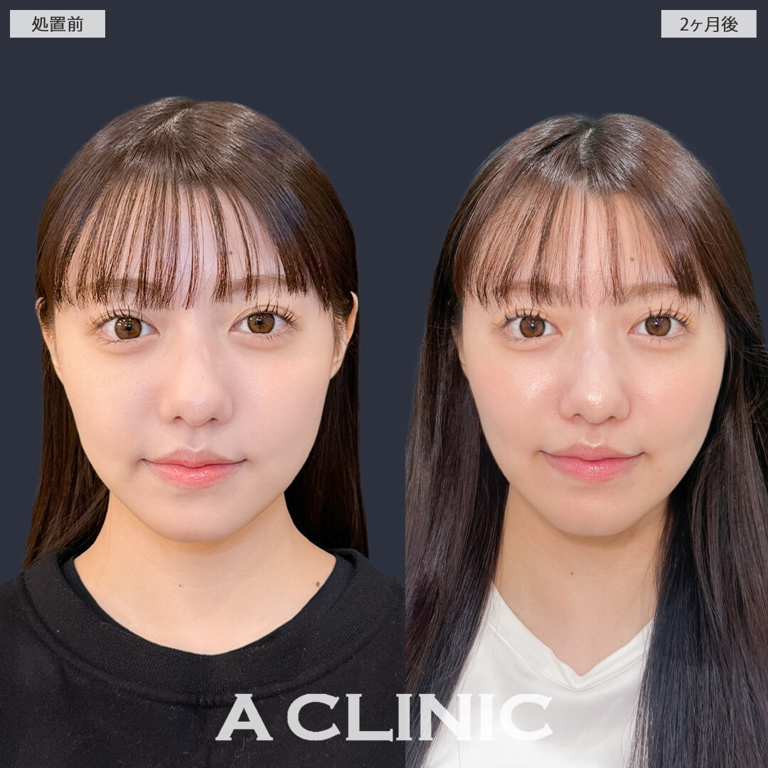 1day小顔脂肪吸引でエラ下もフェイスラインもすっきりしました！こちら処置前と2ヶ月後の症例です(20代女性)