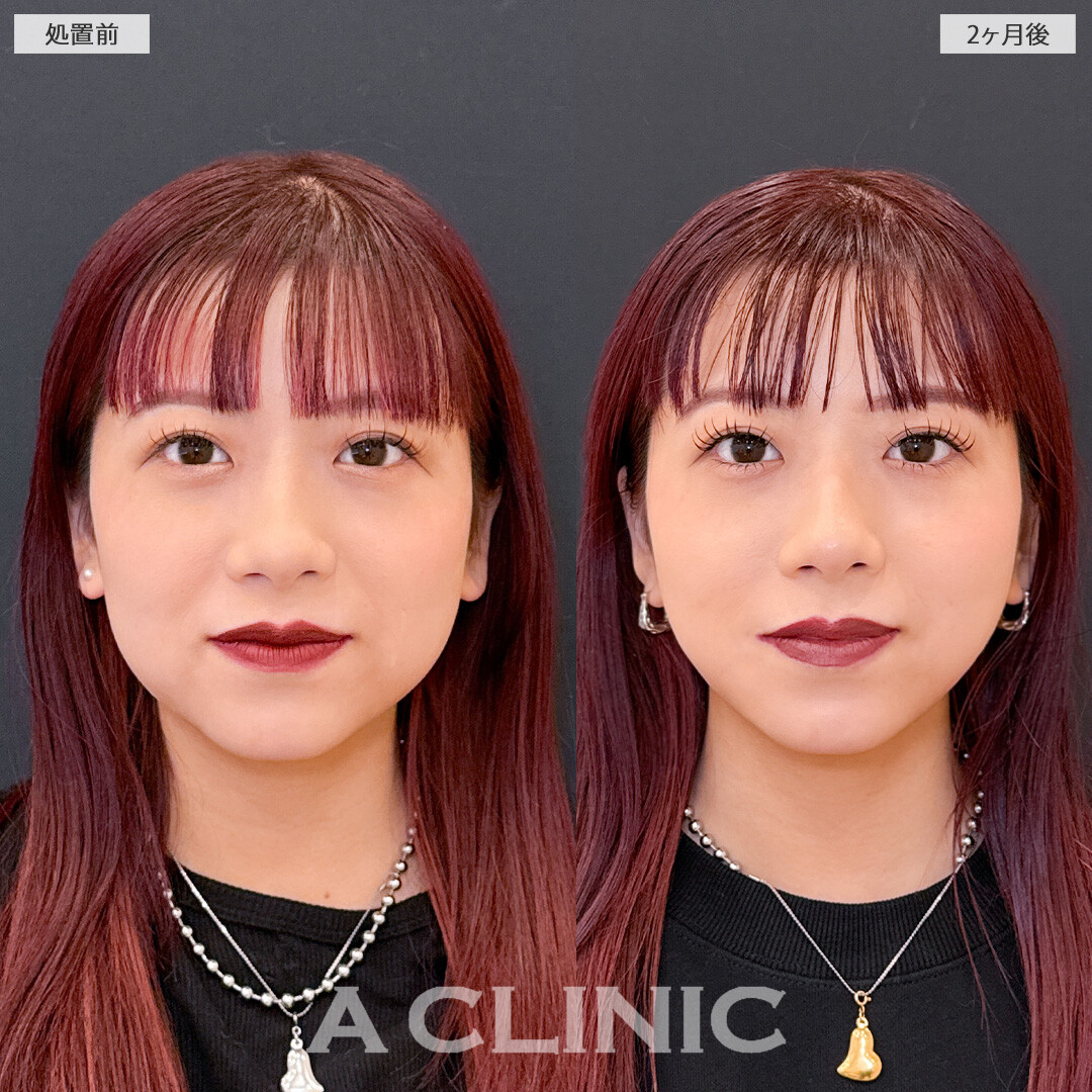 1day小顔脂肪吸引で脂肪のもたつきを減らして垢抜け小顔に！こちら処置前と2ヶ月後の症例です(20代女性)