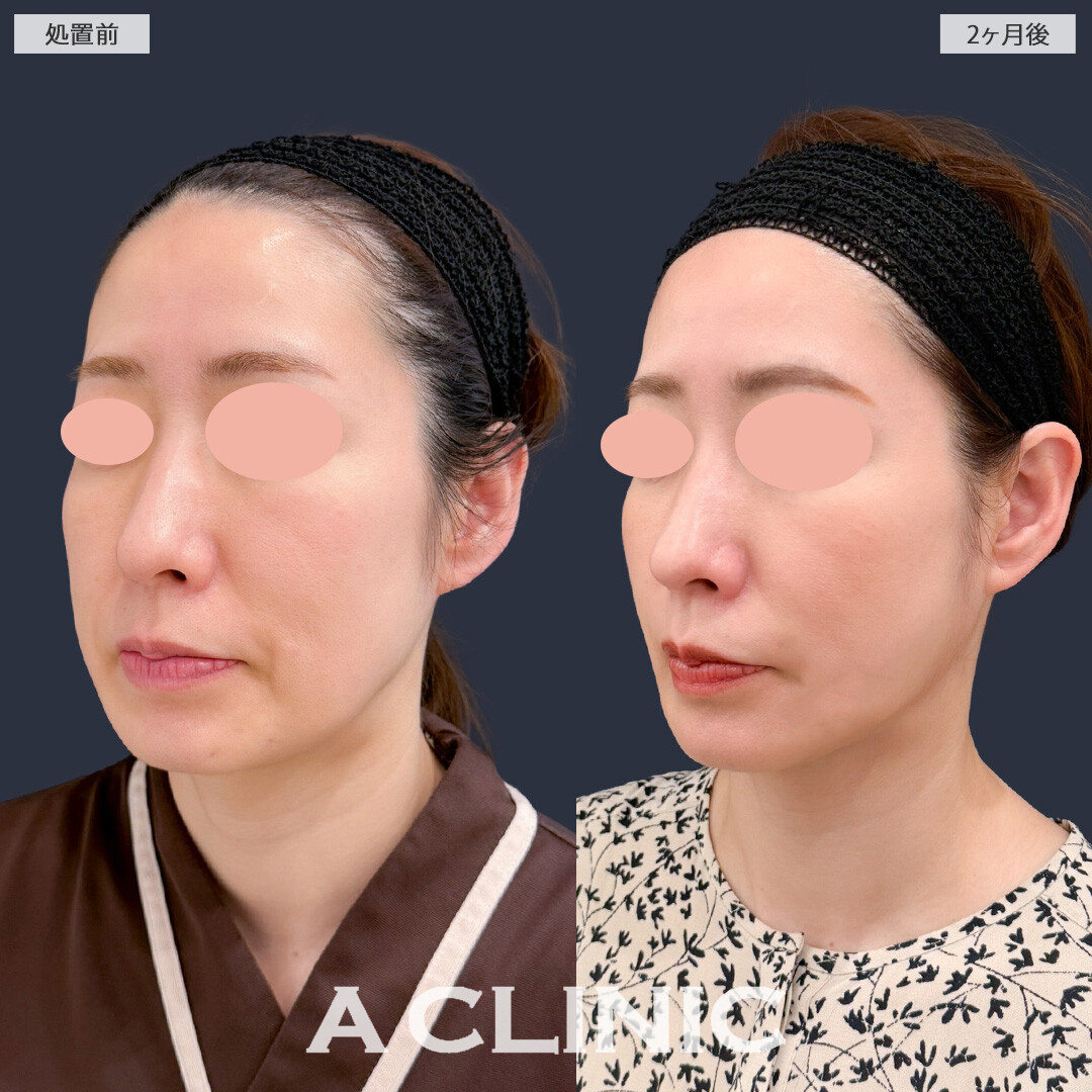 1day小顔脂肪吸引でフェイスラインがすっきりし理想の小顔になれました！こちら処置前と2ヶ月後の症例です(40代女性)