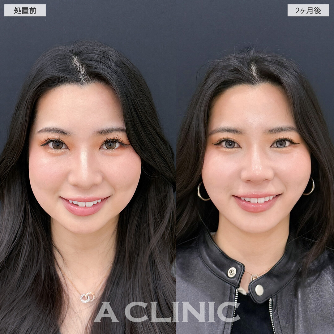 1day小顔脂肪吸引とバッカルファット除去術で丸顔感をなくして余白のないVフェイスに！こちら処置前と2ヶ月後の症例です(20代女性)