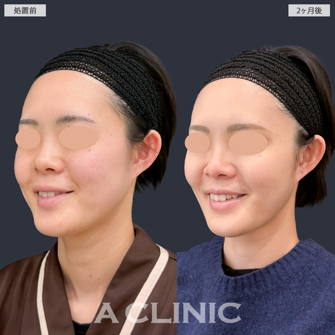 1day小顔脂肪吸引とバッカルファット除去術でお顔の余白を減らしてナチュラルな小顔に！こちら処置前と2ヶ月後の症例です(30代女性)