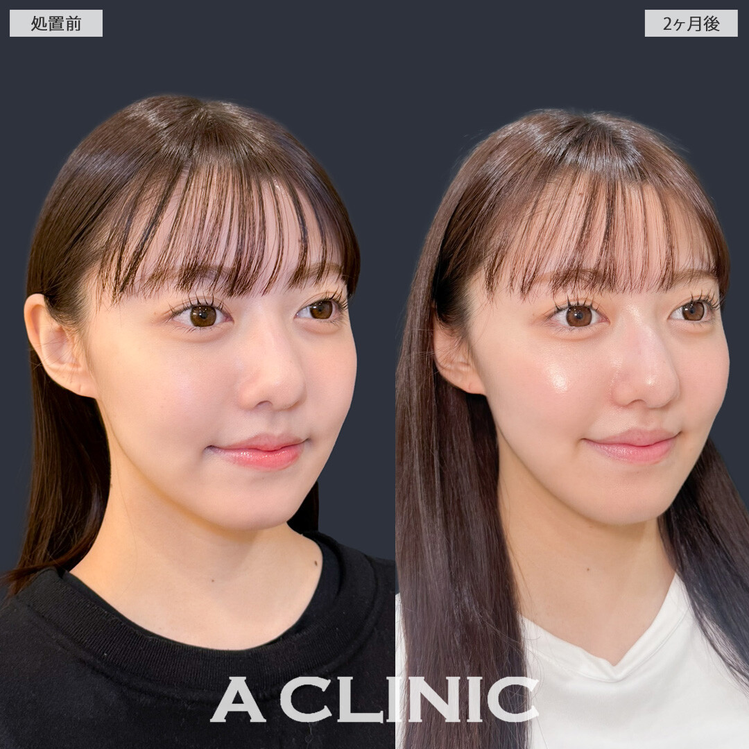 1day小顔脂肪吸引でエラ下もフェイスラインもすっきりしました！こちら処置前と2ヶ月後の症例です(20代女性)