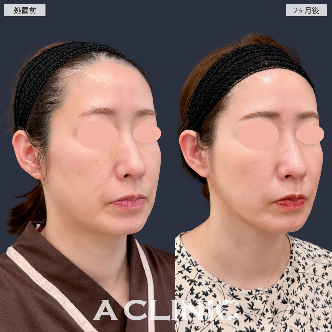 1day小顔脂肪吸引でフェイスラインがすっきりし理想の小顔になれました！こちら処置前と2ヶ月後の症例です(40代女性)