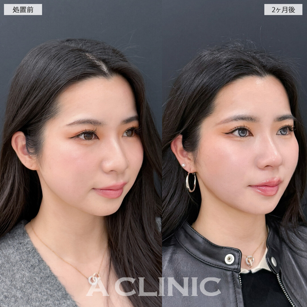 1day小顔脂肪吸引とバッカルファット除去術で丸顔感をなくして余白のないVフェイスに！こちら処置前と2ヶ月後の症例です(20代女性)