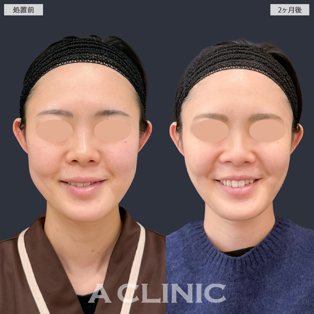 1day小顔脂肪吸引とバッカルファット除去術でお顔の余白を減らしてナチュラルな小顔に！こちら処置前と2ヶ月後の症例です(30代女性)