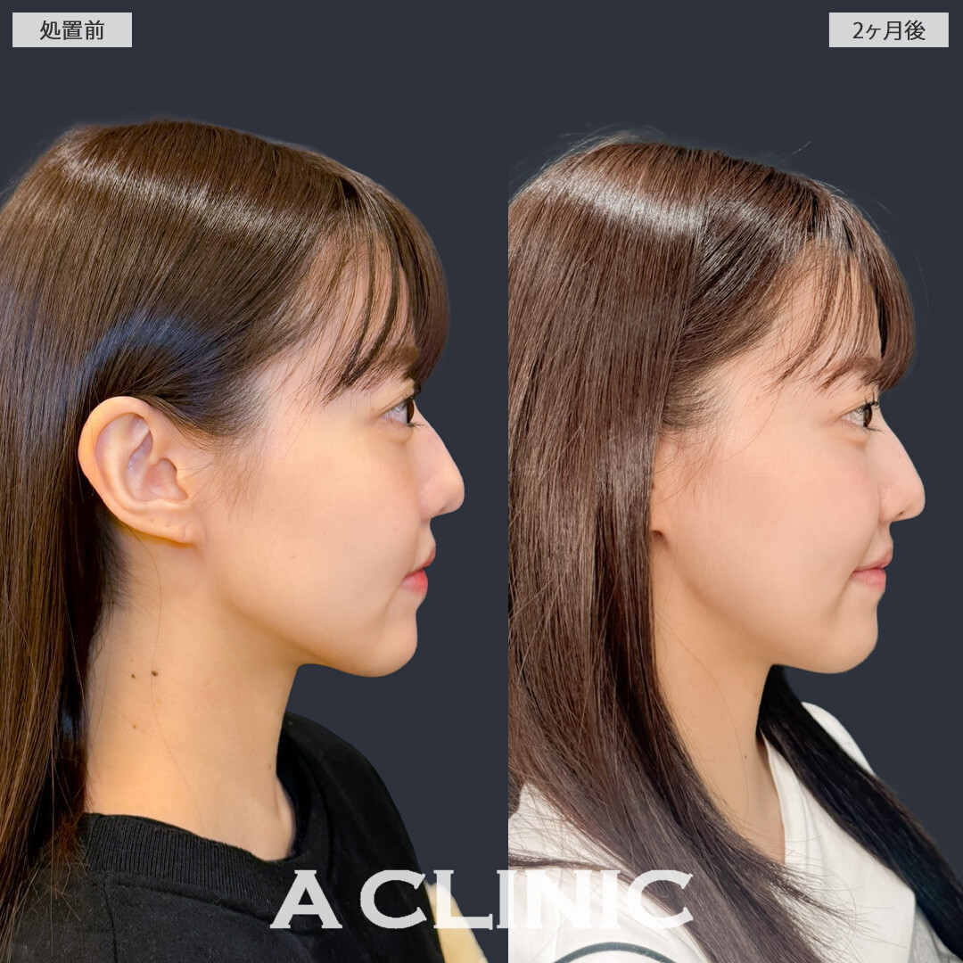 1day小顔脂肪吸引でエラ下もフェイスラインもすっきりしました！こちら処置前と2ヶ月後の症例です(20代女性)