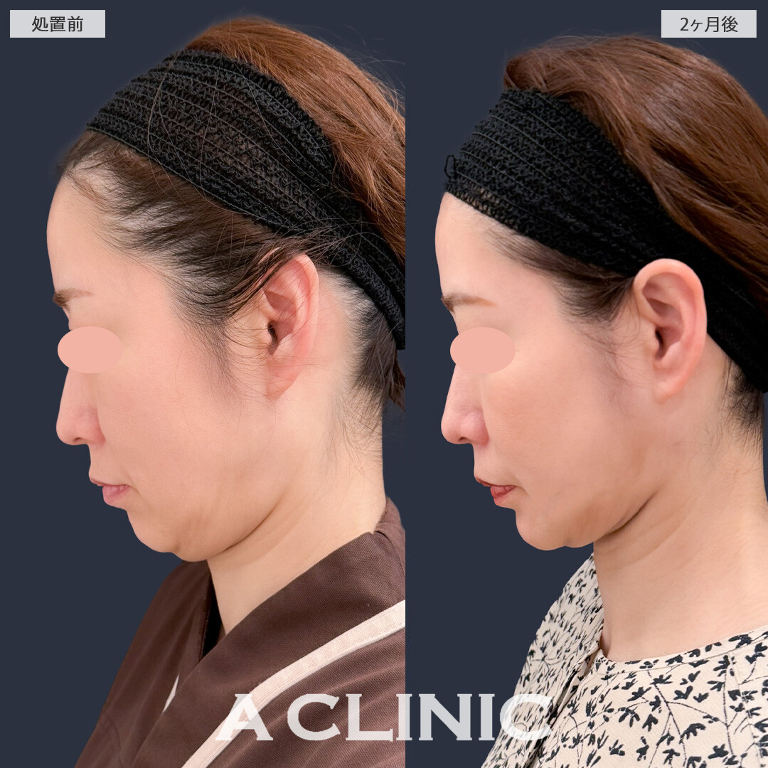 1day小顔脂肪吸引でフェイスラインがすっきりし理想の小顔になれました！こちら処置前と2ヶ月後の症例です(40代女性)