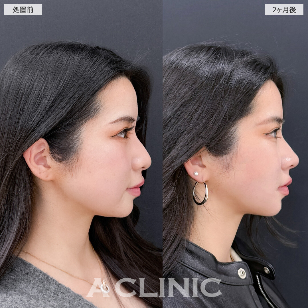 1day小顔脂肪吸引とバッカルファット除去術で丸顔感をなくして余白のないVフェイスに！こちら処置前と2ヶ月後の症例です(20代女性)