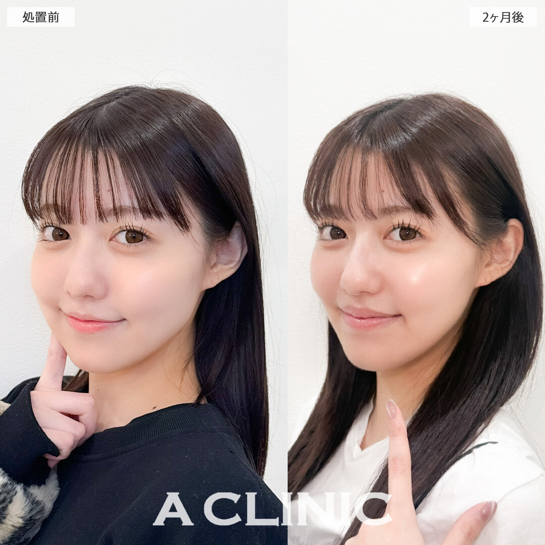 1day小顔脂肪吸引でエラ下もフェイスラインもすっきりしました！こちら処置前と2ヶ月後の症例です(20代女性)