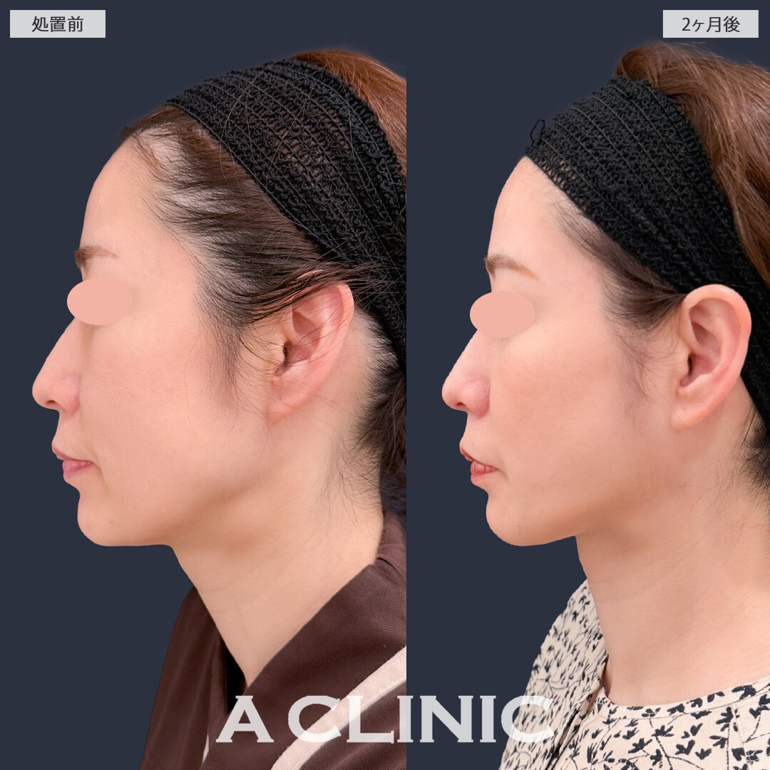 1day小顔脂肪吸引でフェイスラインがすっきりし理想の小顔になれました！こちら処置前と2ヶ月後の症例です(40代女性)