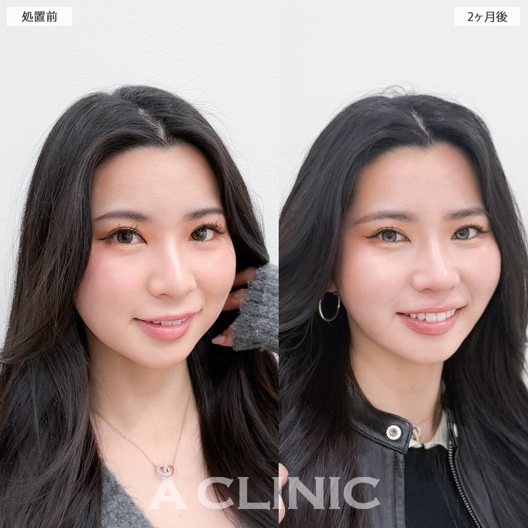 1day小顔脂肪吸引とバッカルファット除去術で丸顔感をなくして余白のないVフェイスに！こちら処置前と2ヶ月後の症例です(20代女性)