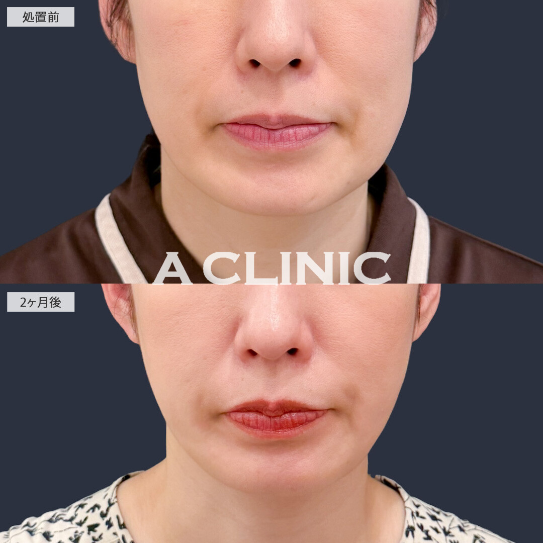 1day小顔脂肪吸引でフェイスラインがすっきりし理想の小顔になれました！こちら処置前と2ヶ月後の症例です(40代女性)