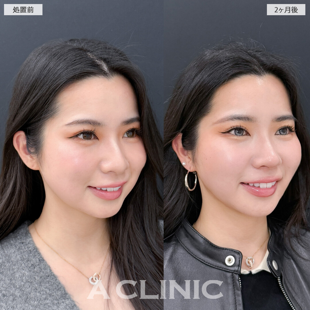 1day小顔脂肪吸引とバッカルファット除去術で丸顔感をなくして余白のないVフェイスに！こちら処置前と2ヶ月後の症例です(20代女性)