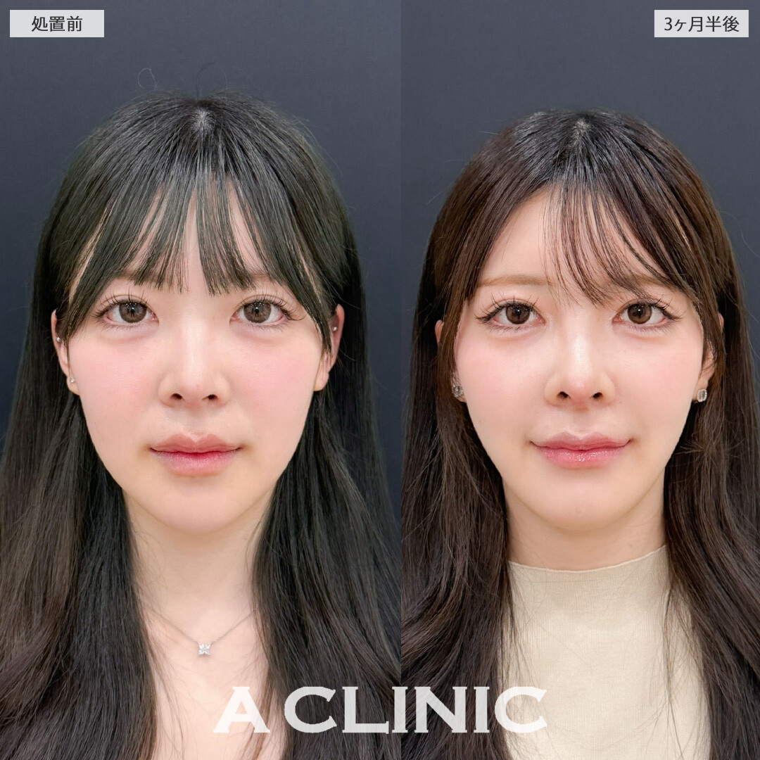 1day小顔脂肪吸引と小顔エラボトックスでVフェイスの爆美女になれました！こちら処置前と3か月半後の症例です(20代女性)