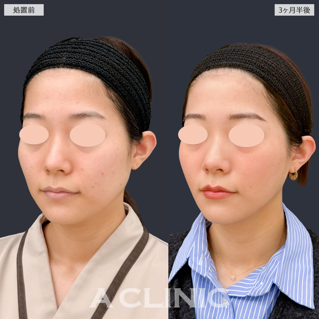 1day小顔脂肪吸引でフェイスラインが自然にすっきりしました！こちら処置前と3か月半後の症例です(30代女性)