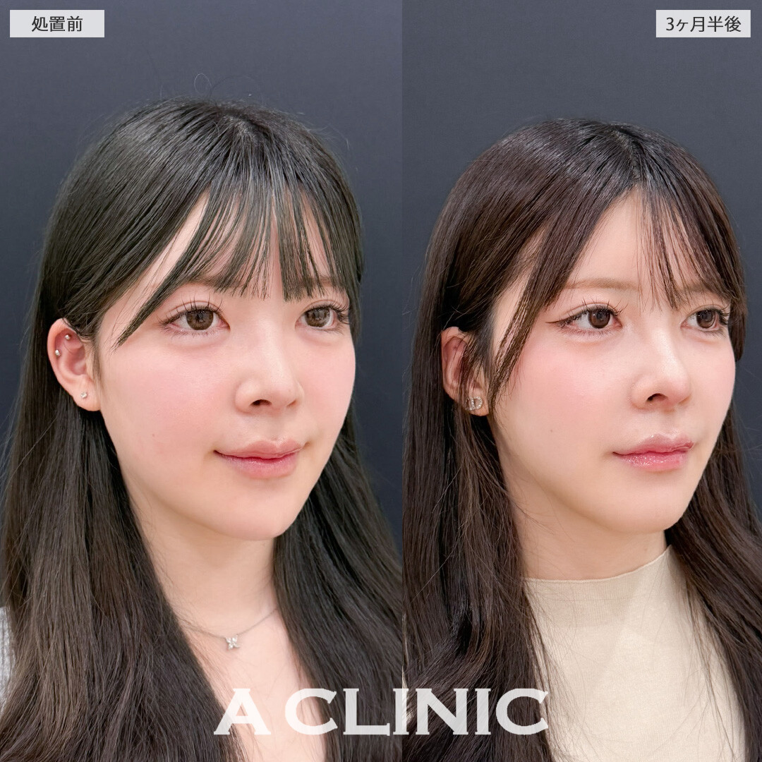 1day小顔脂肪吸引と小顔エラボトックスでVフェイスの爆美女になれました！こちら処置前と3か月半後の症例です(20代女性)
