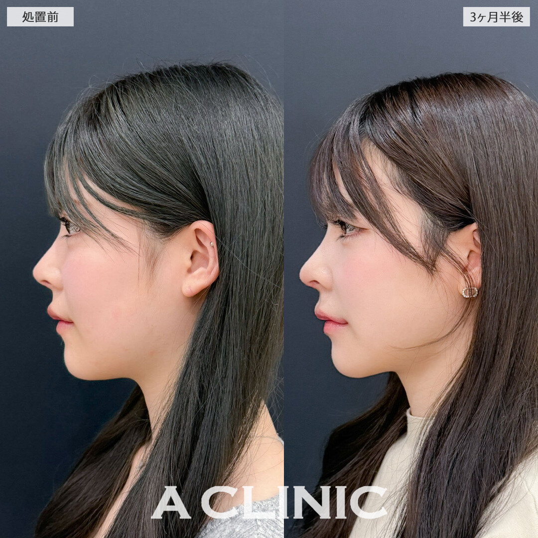 1day小顔脂肪吸引と小顔エラボトックスでVフェイスの爆美女になれました！こちら処置前と3か月半後の症例です(20代女性)
