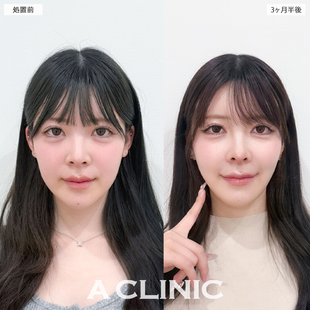 1day小顔脂肪吸引と小顔エラボトックスでVフェイスの爆美女になれました！こちら処置前と3か月半後の症例です(20代女性)