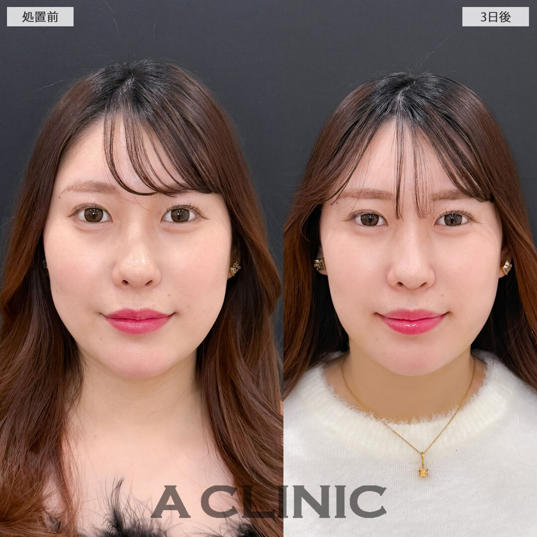 1day小顔脂肪吸引とバッカルファット除去術で笑った時に気になるお肉をなくせます！こちら処置前と3日後の症例です(30代女性)
