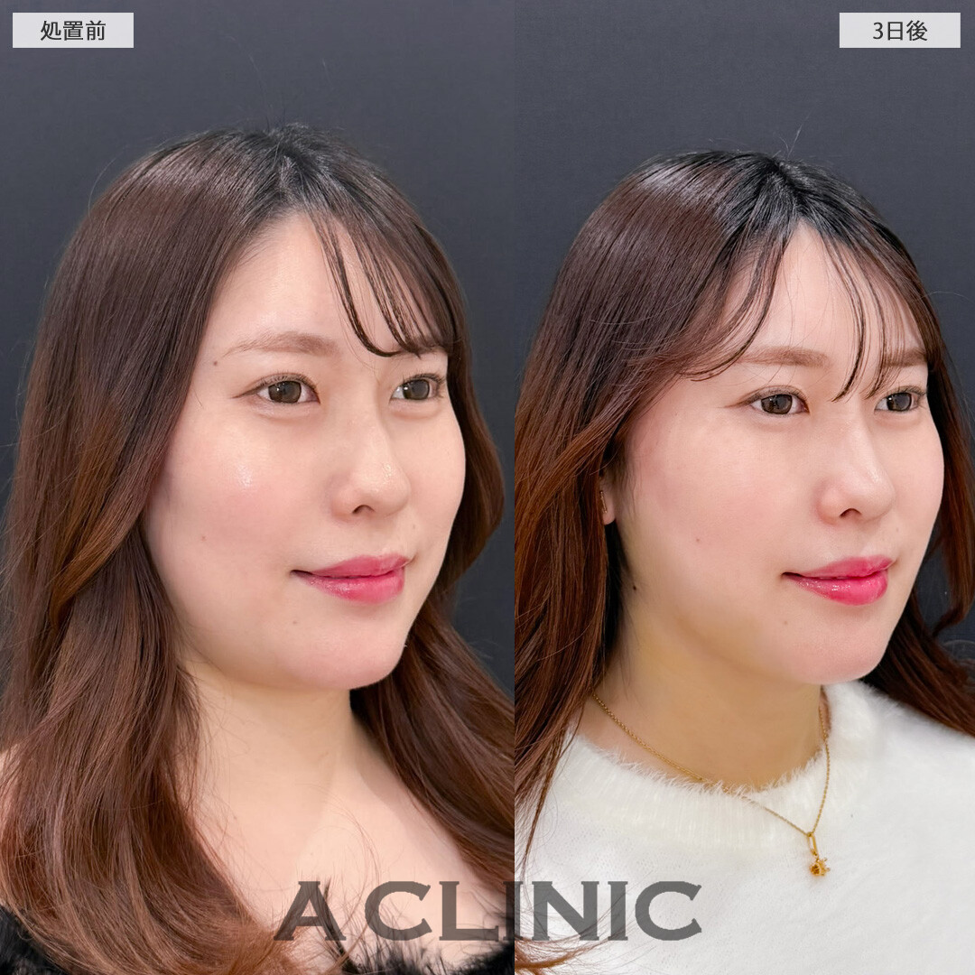 1day小顔脂肪吸引とバッカルファット除去術で笑った時に気になるお肉をなくせます！こちら処置前と3日後の症例です(30代女性)