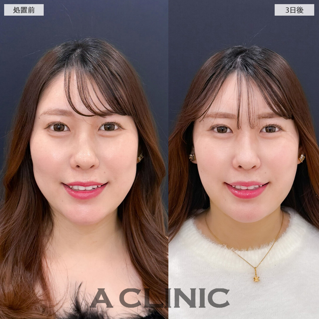 1day小顔脂肪吸引とバッカルファット除去術で笑った時に気になるお肉をなくせます！こちら処置前と3日後の症例です(30代女性)