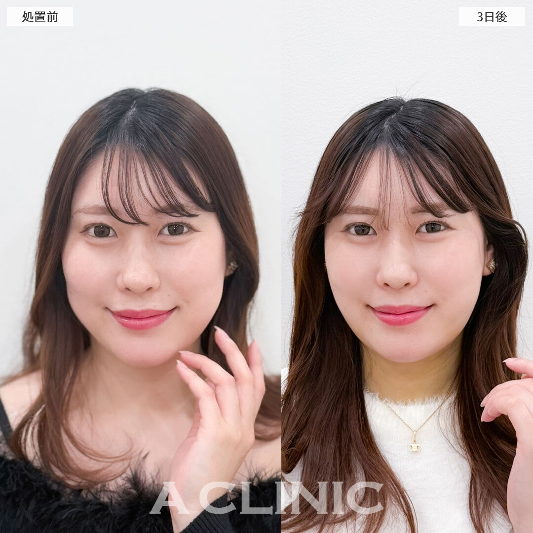 1day小顔脂肪吸引とバッカルファット除去術で笑った時に気になるお肉をなくせます！こちら処置前と3日後の症例です(30代女性)