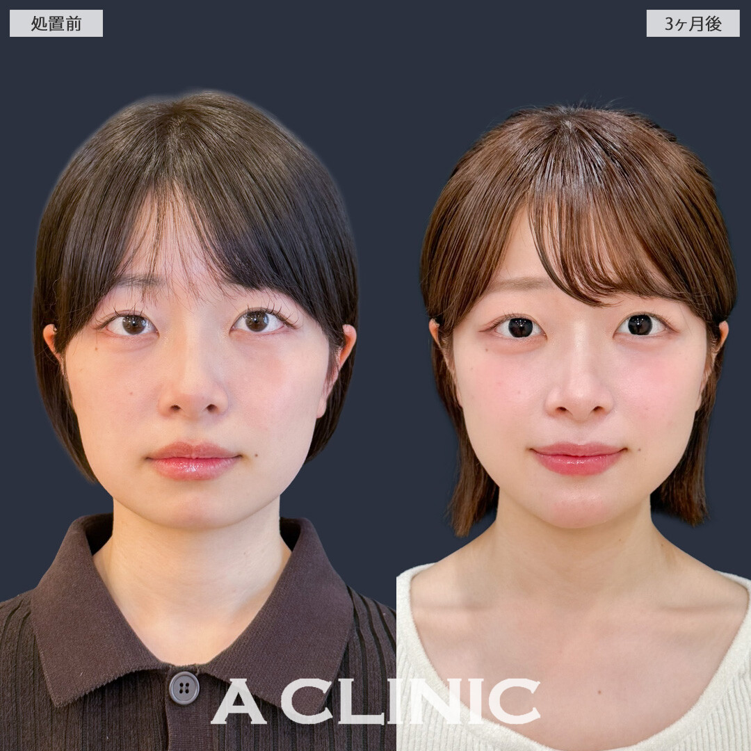 1day小顔脂肪吸引で丸顔さんもきれいなフェイスラインを手に入れることができました！こちら処置前と3か月後の症例です(20代女性)