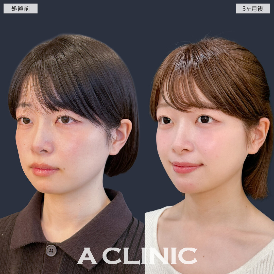 1day小顔脂肪吸引で丸顔さんもきれいなフェイスラインを手に入れることができました！こちら処置前と3か月後の症例です(20代女性)