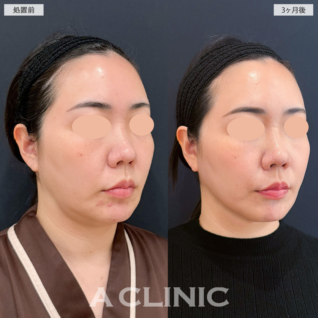 1day小顔脂肪吸引でエラ下とあご下がかなりすっきりしました！こちら処置前と3か月後の症例です(40代女性)