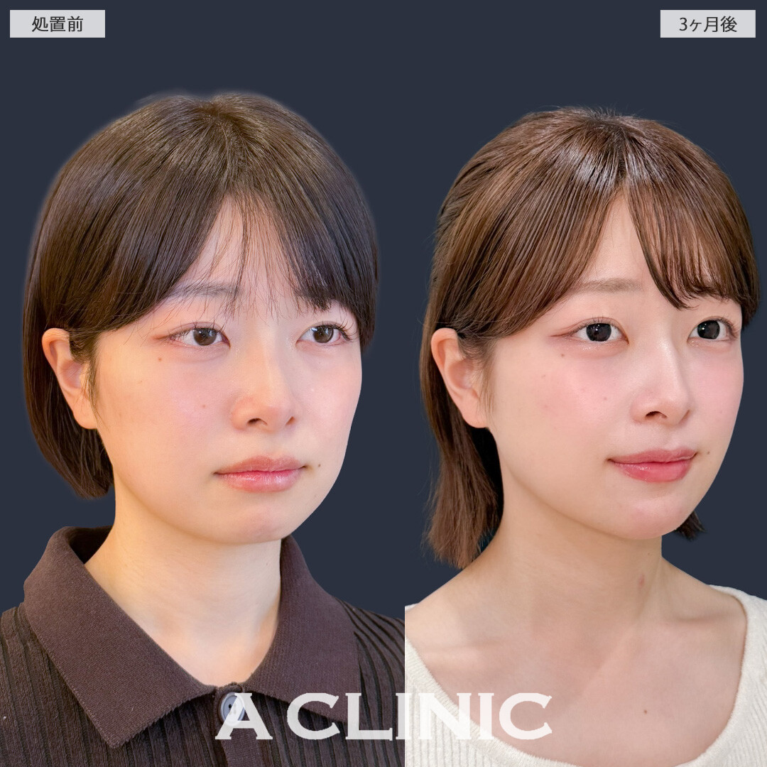 1day小顔脂肪吸引で丸顔さんもきれいなフェイスラインを手に入れることができました！こちら処置前と3か月後の症例です(20代女性)