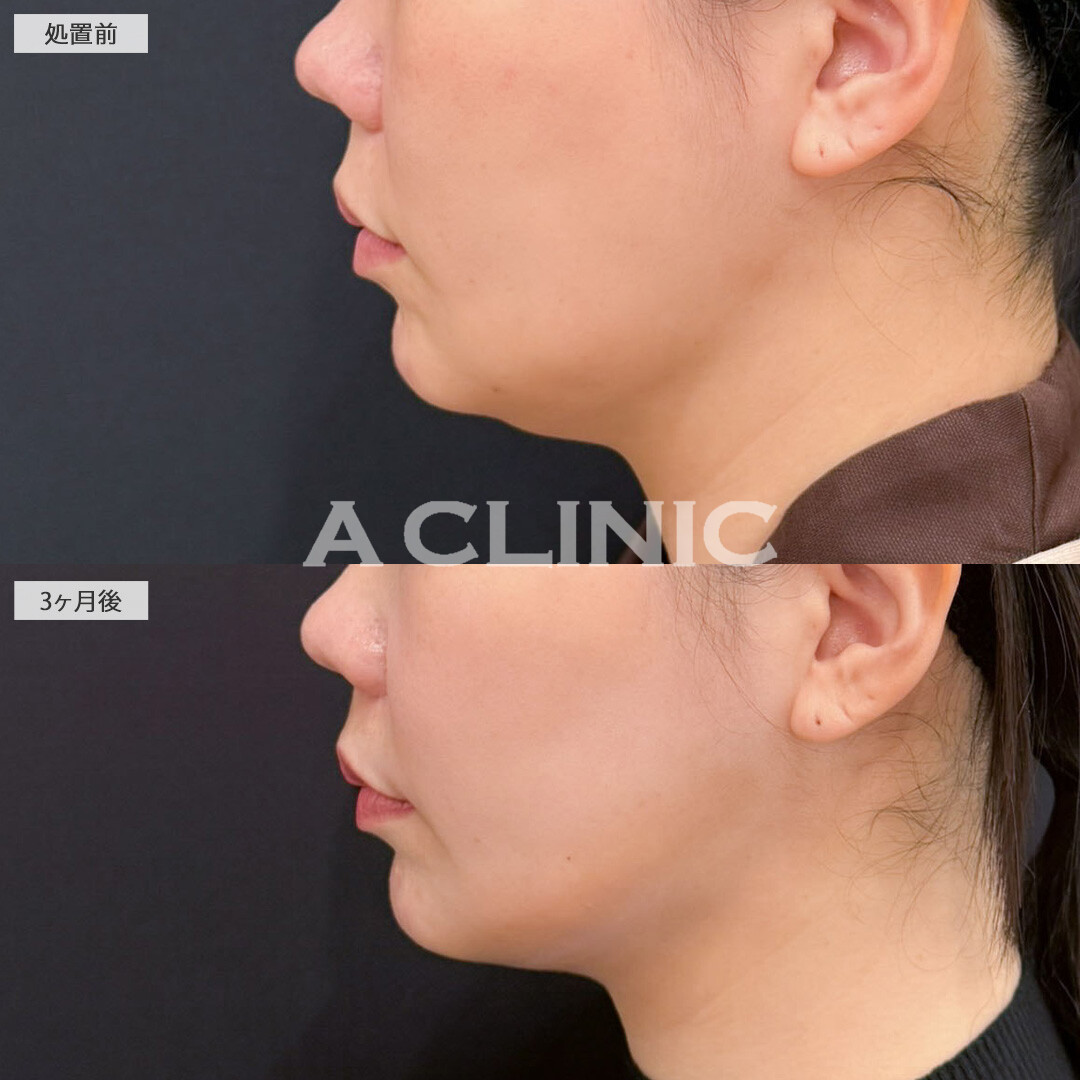 1day小顔脂肪吸引でエラ下とあご下がかなりすっきりしました！こちら処置前と3か月後の症例です(40代女性)