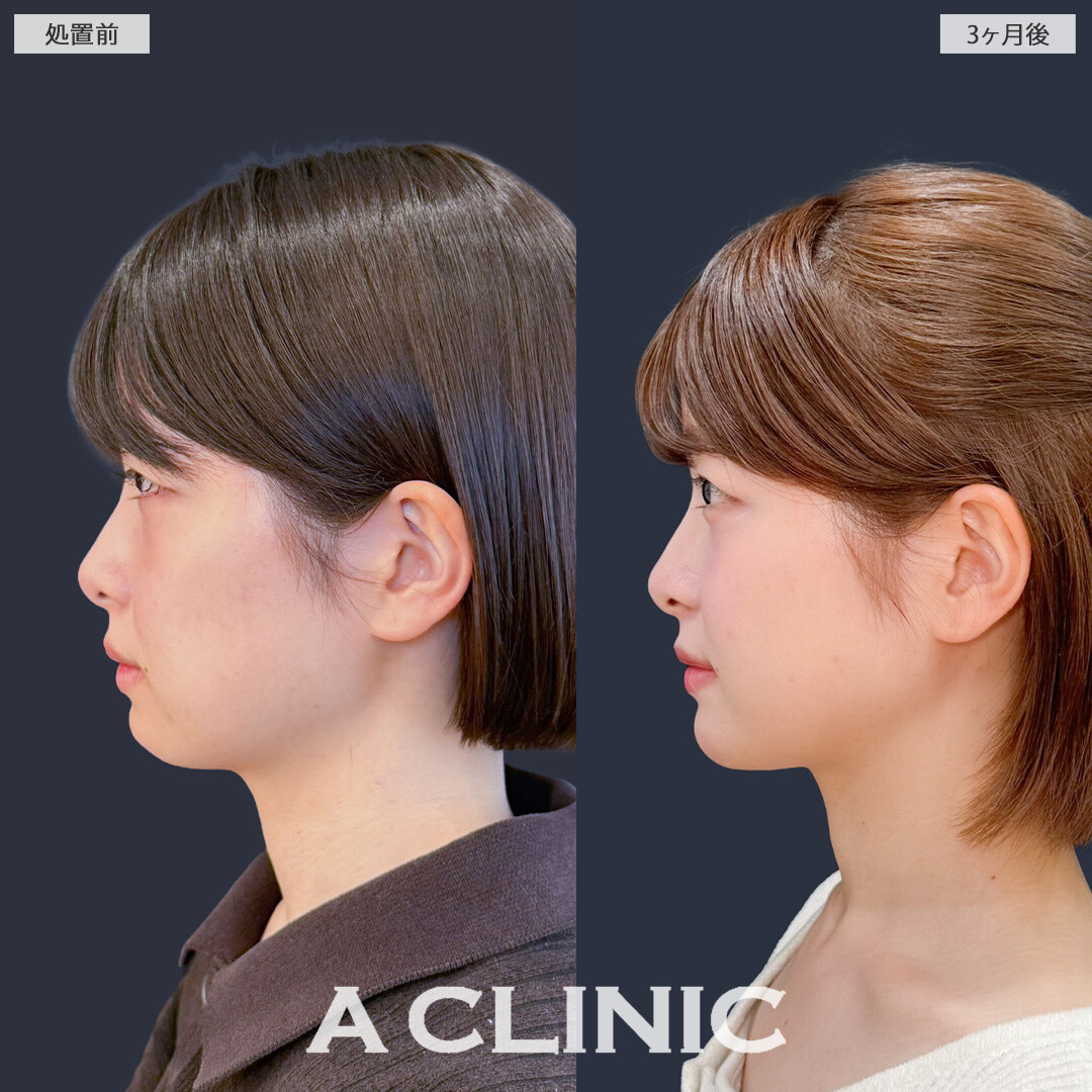 1day小顔脂肪吸引で丸顔さんもきれいなフェイスラインを手に入れることができました！こちら処置前と3か月後の症例です(20代女性)
