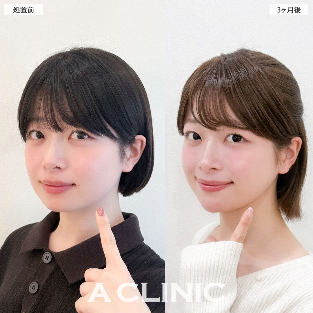 1day小顔脂肪吸引で丸顔さんもきれいなフェイスラインを手に入れることができました！こちら処置前と3か月後の症例です(20代女性)