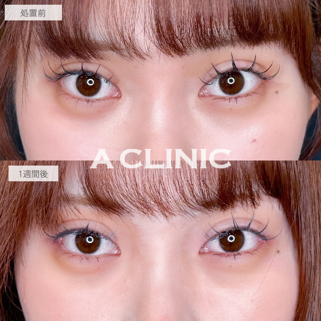 パーフェクトアイズでつり目を緩和させて優しい印象の目元になりました！こちら処置前と1週間後の症例です(20代女性)