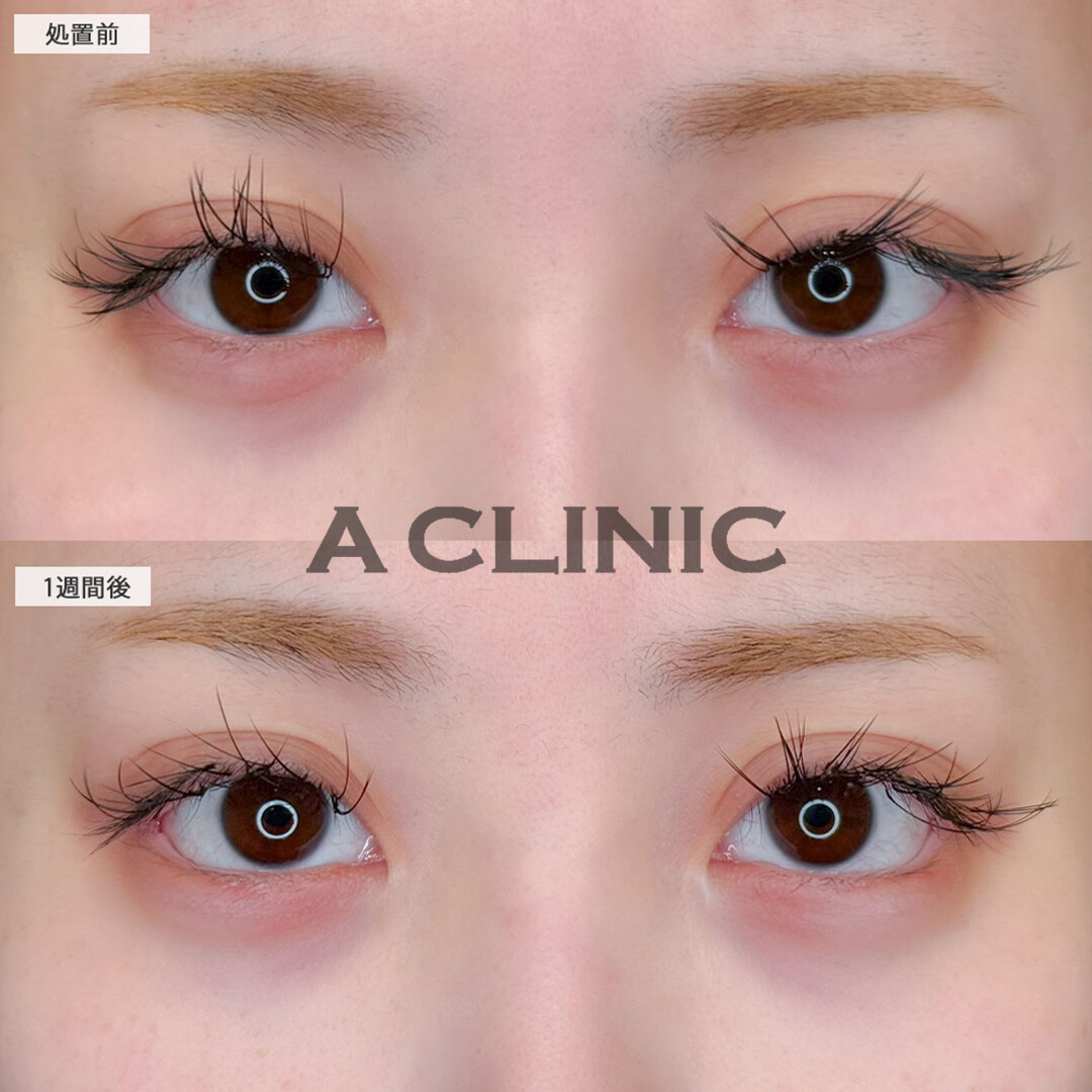 パーフェクトアイズでぱっちりたれ目な目元に！こちら処置前と1週間後の症例です(20代女性)