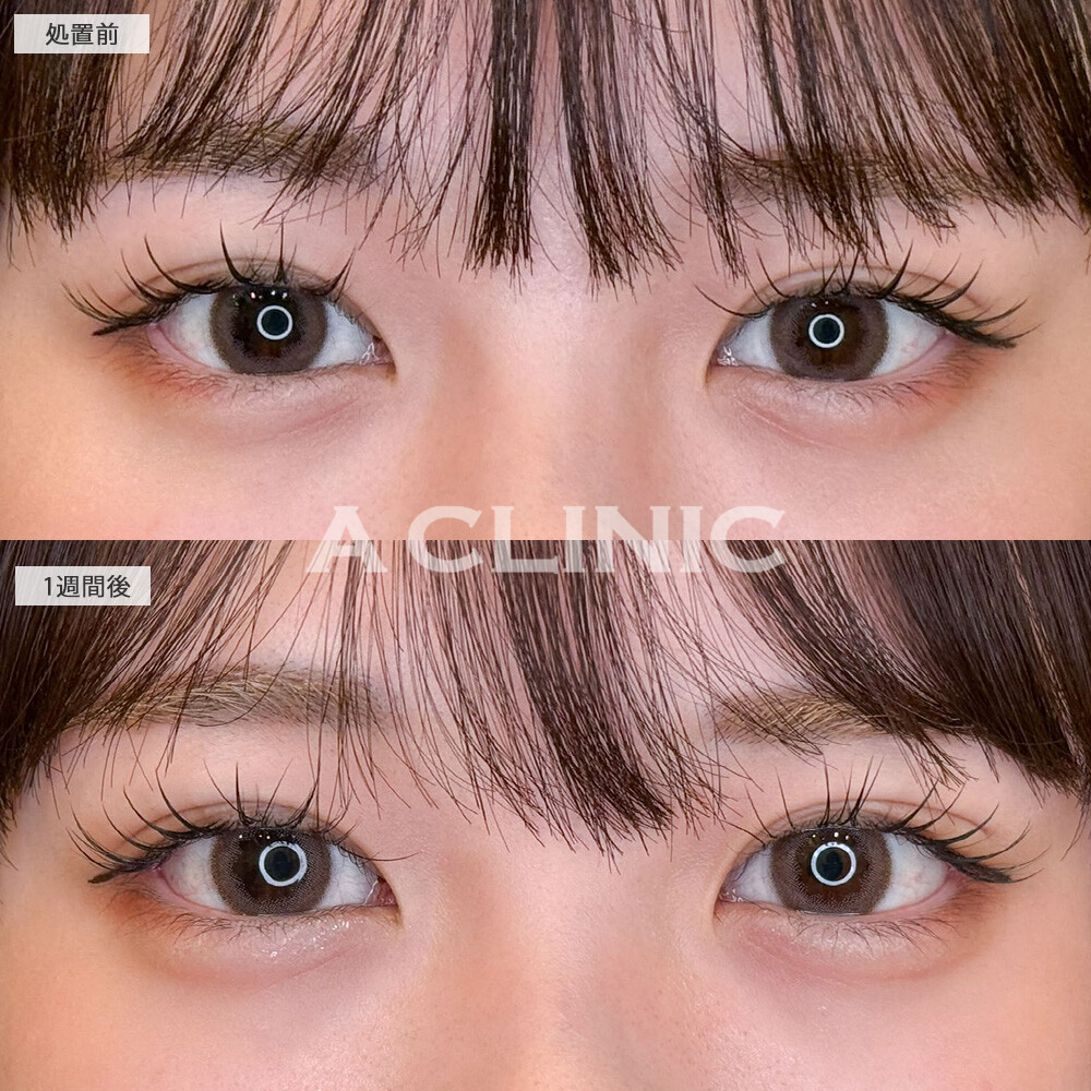 パーフェクトアイズで加工必須だった目元が自然に大きく優しい印象になりました！こちら処置前と１週間後の症例です(20代女性)