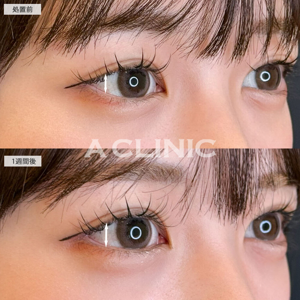 パーフェクトアイズで加工必須だった目元が自然に大きく優しい印象になりました！こちら処置前と１週間後の症例です(20代女性)