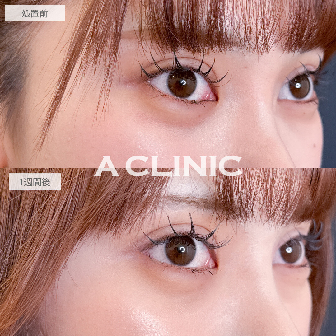 パーフェクトアイズでつり目を緩和させて優しい印象の目元になりました！こちら処置前と1週間後の症例です(20代女性)