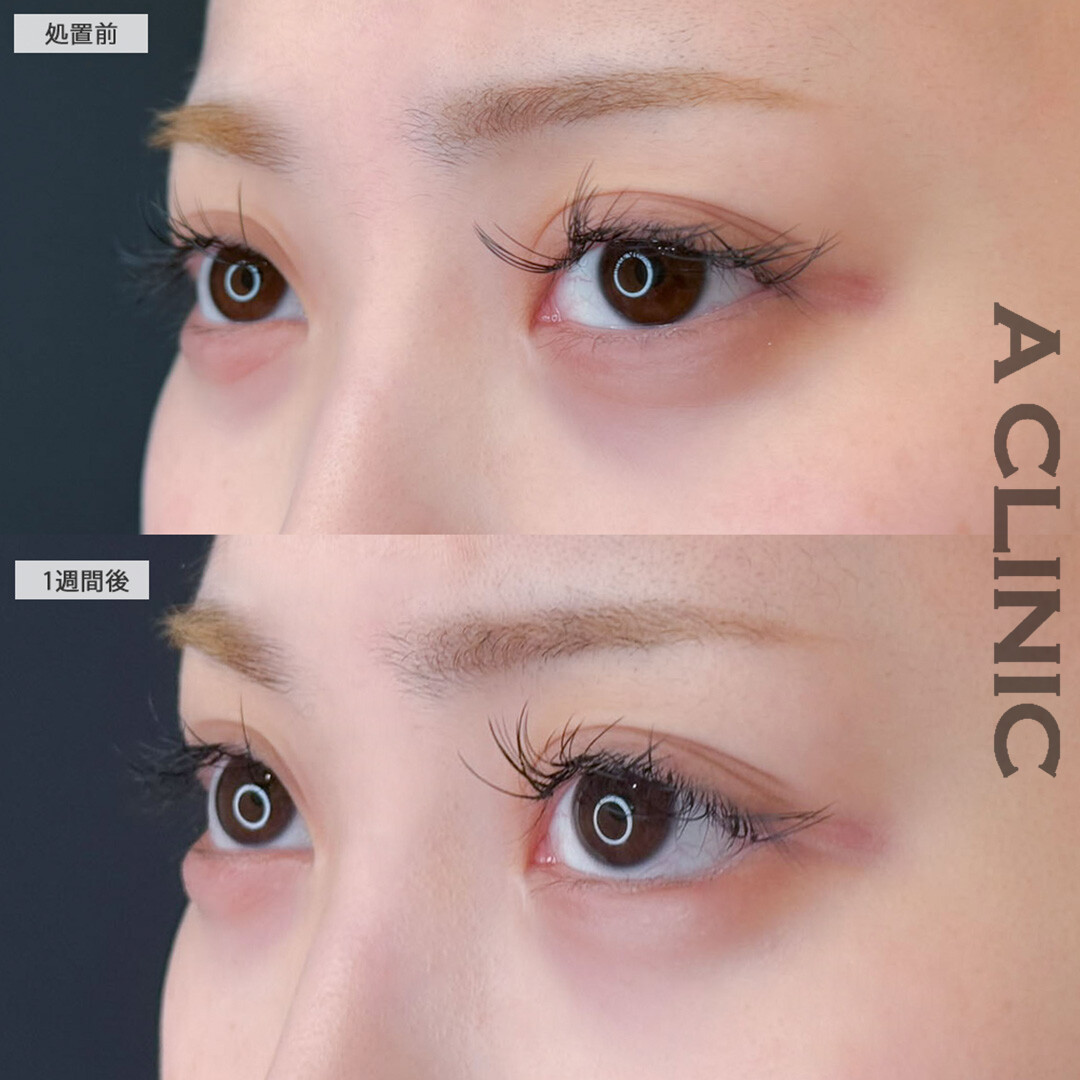 パーフェクトアイズでぱっちりたれ目な目元に！こちら処置前と1週間後の症例です(20代女性)