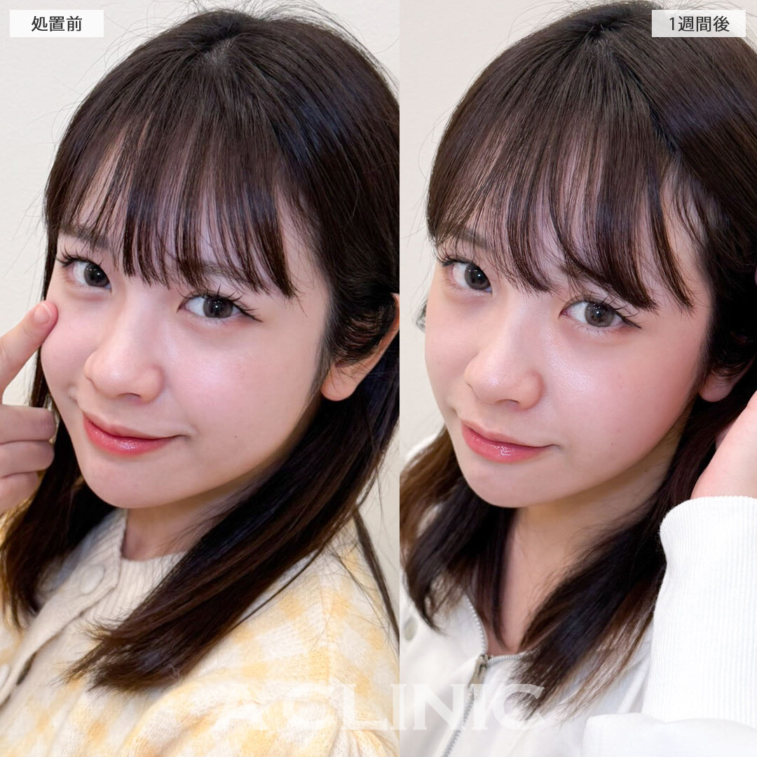 パーフェクトアイズで加工必須だった目元が自然に大きく優しい印象になりました！こちら処置前と１週間後の症例です(20代女性)